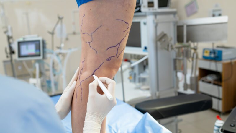 Angiologia: descarte de esclerose, biópsia e procedimentos vasculares ambulatoriais
