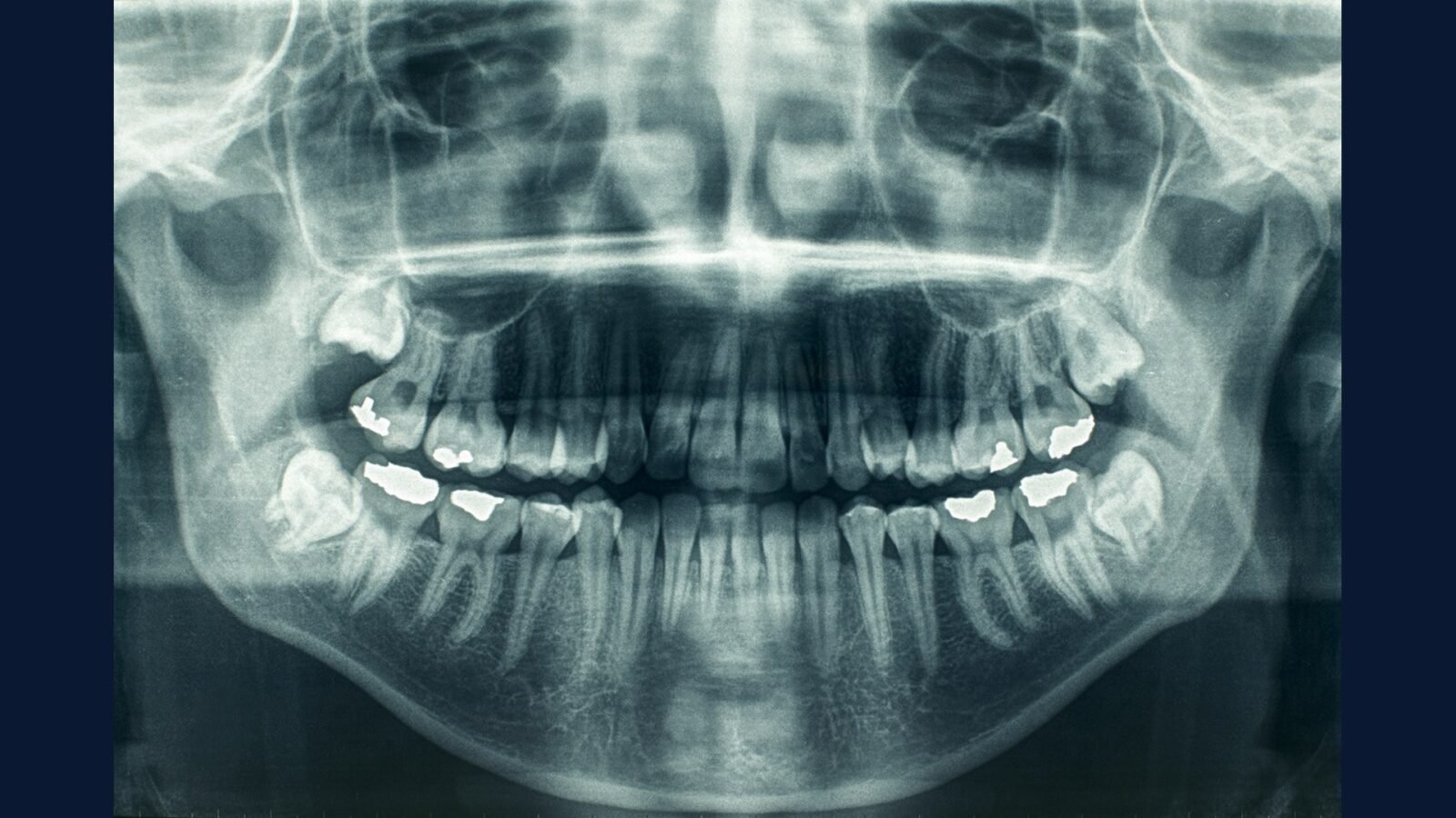 Caso real: dentista multado R$ 95 mil por amálgama