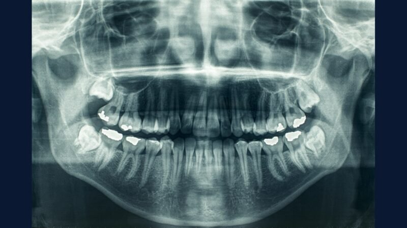 Caso real: dentista multado R$ 95 mil por amálgama