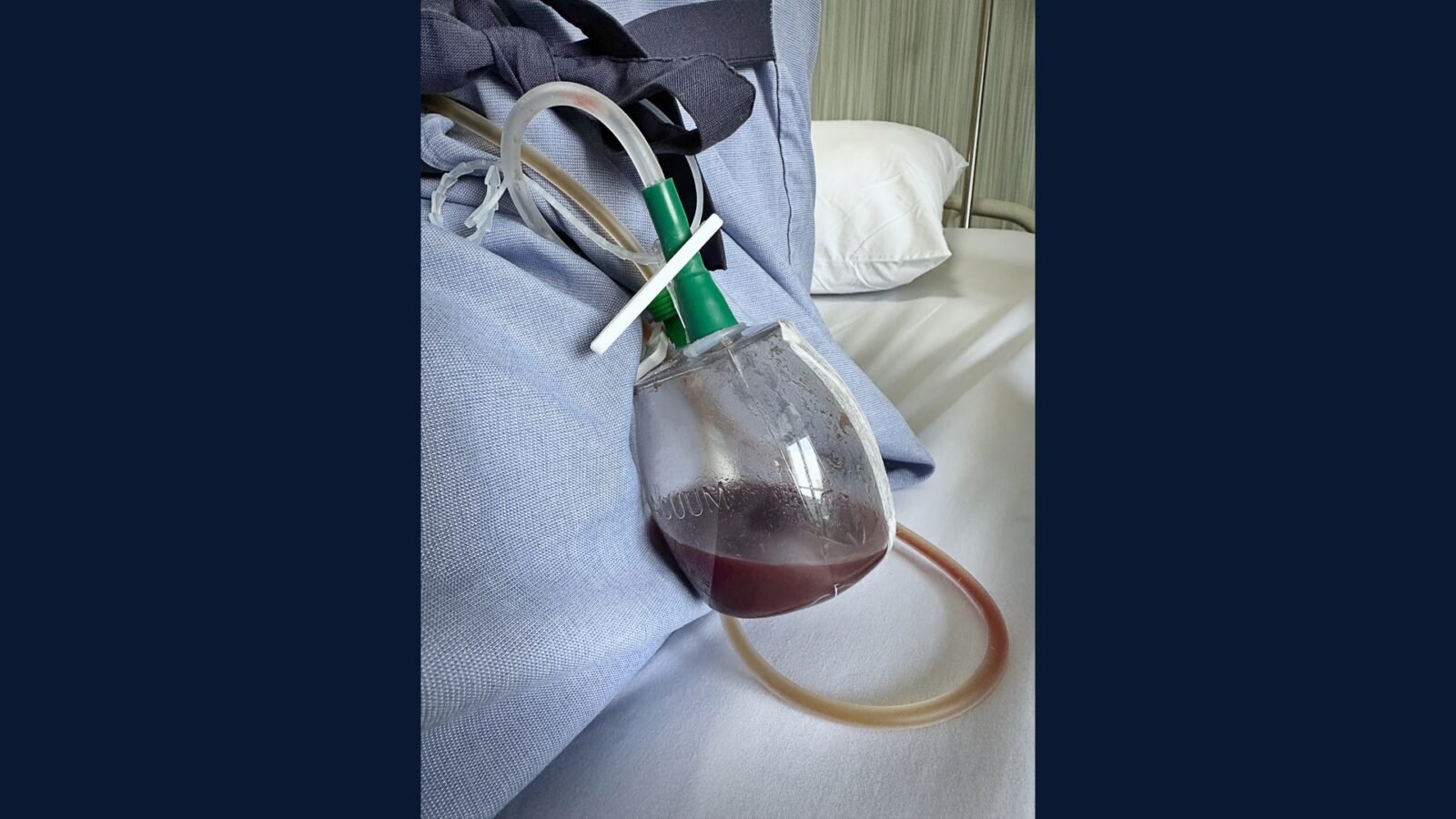 Como Descartar Bolsa Coletora de Urina