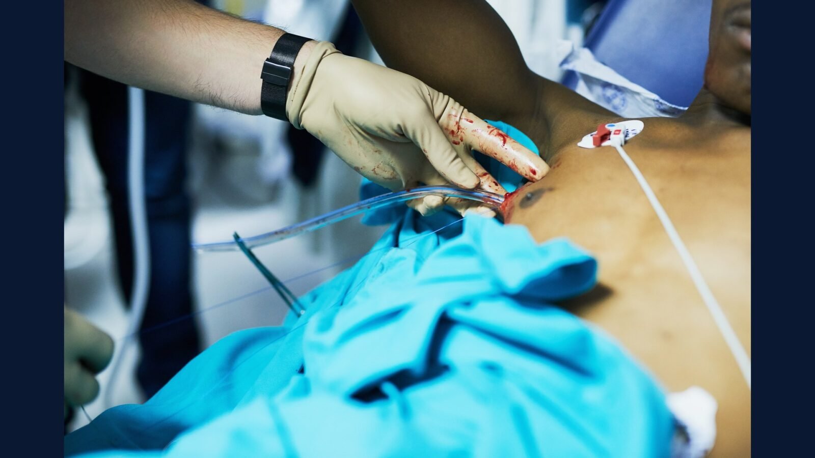 Como Descartar Material Endovascular