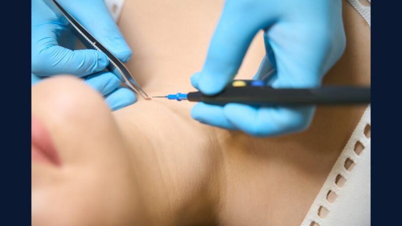 Como Descartar Resíduo de Cauterização na Clínica