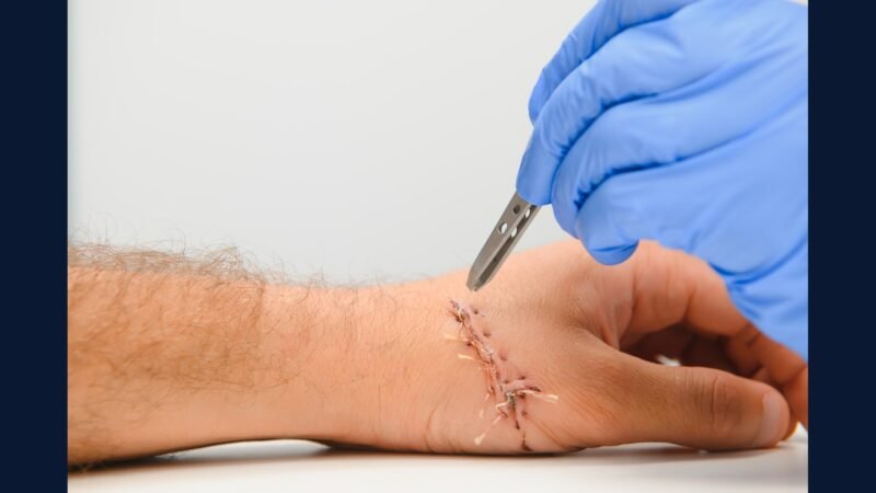 Como Descartar Resíduo de Exérese de Cisto e Lipoma