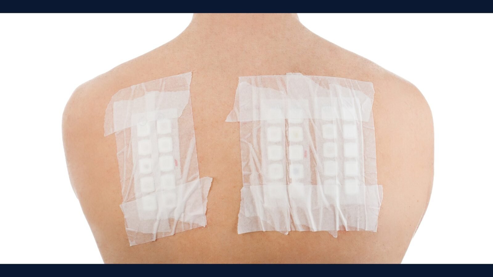 Como Descartar Resíduo de Teste de Contato (Patch Test)
