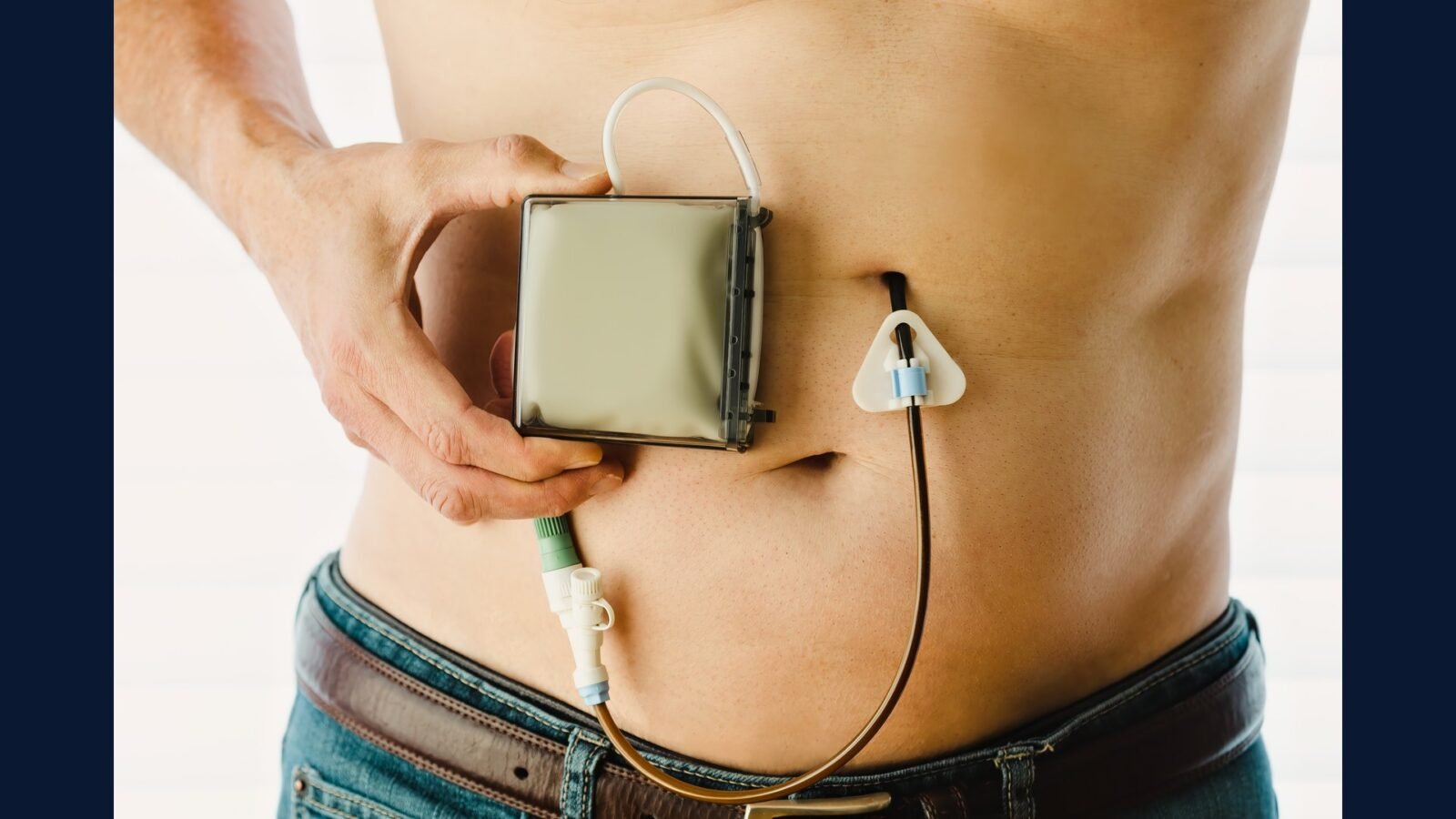 Como Descartar Residuo de Dialise Peritoneal