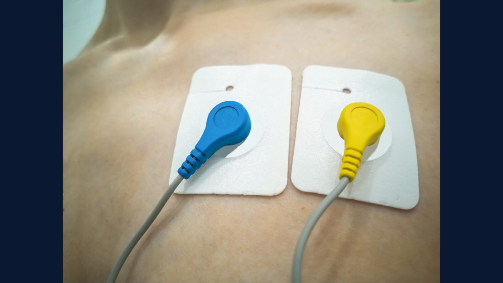 Como Descartar Resíduo de ECG e Eletrodo