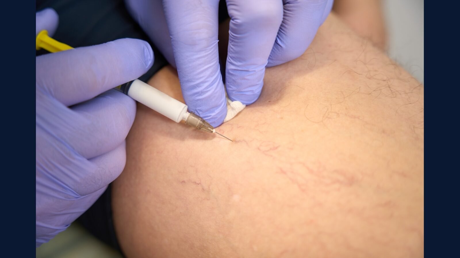 Como Descartar Resíduo de Escleroterapia de Varizes