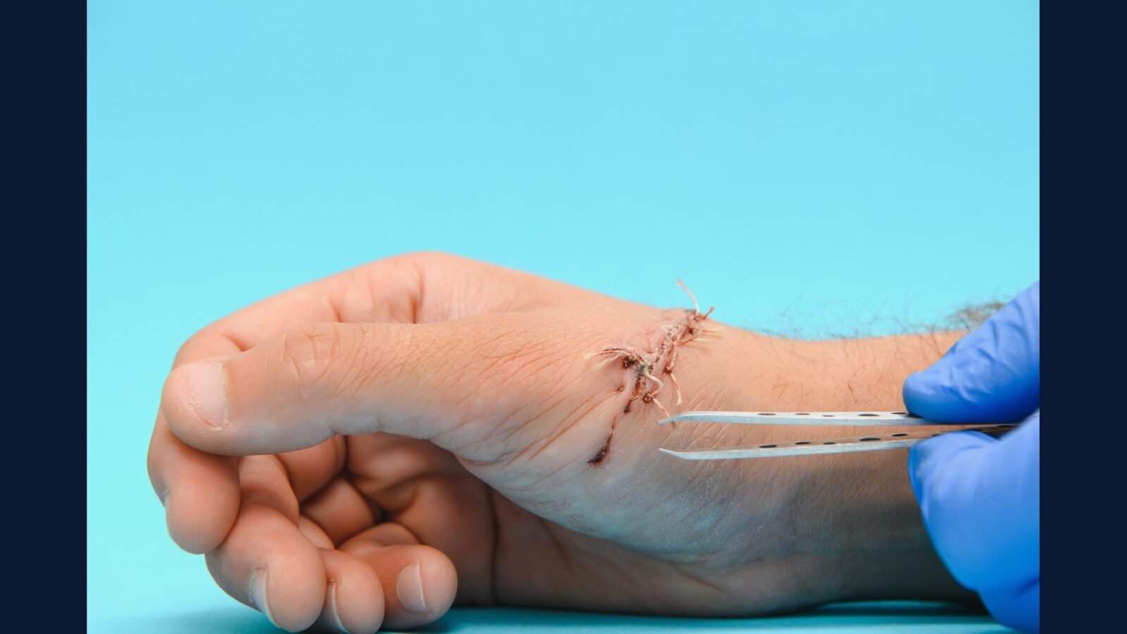 Como Descartar Resíduo de Sutura e Pequena Cirurgia