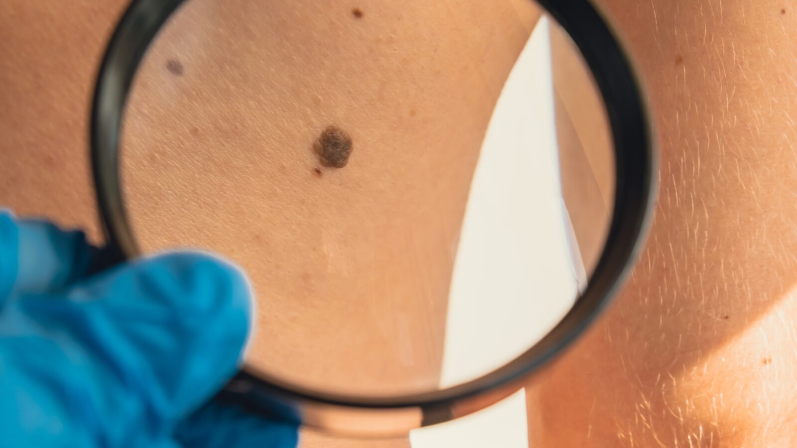 Dermatologia oncológica: descarte de biópsia, criocirurgia e fototerapia em consultório