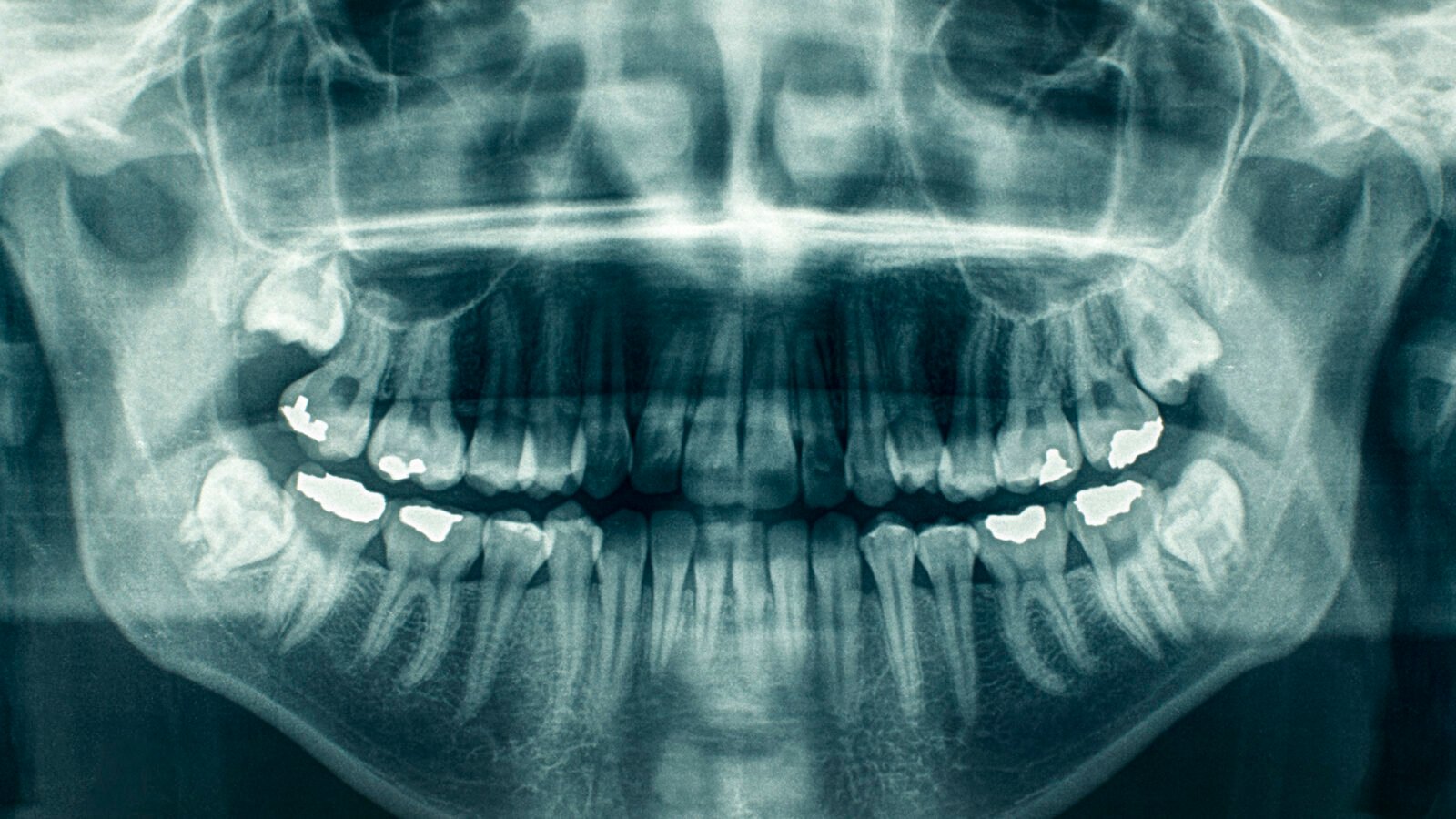 Descarte em radiologia odontológica: revelador, fixador, lâminas de chumbo e como migrar para digital sem deixar passivo