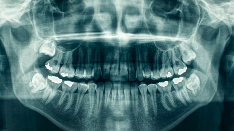 Descarte em radiologia odontológica: revelador, fixador, lâminas de chumbo e como migrar para digital sem deixar passivo