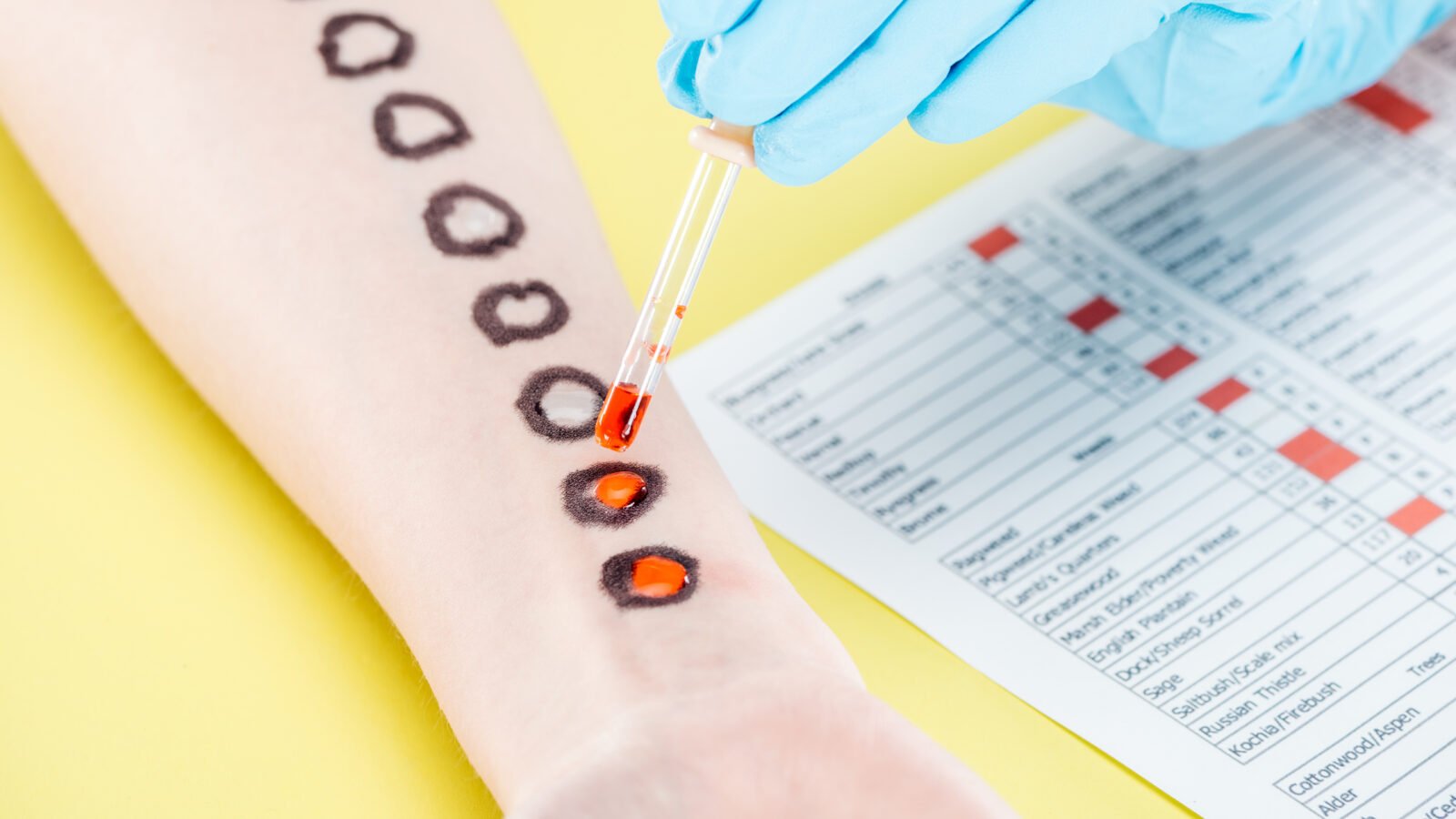 Imunologia e alergia: descarte de testes cutâneos, vacinas de dessensibilização e EPI