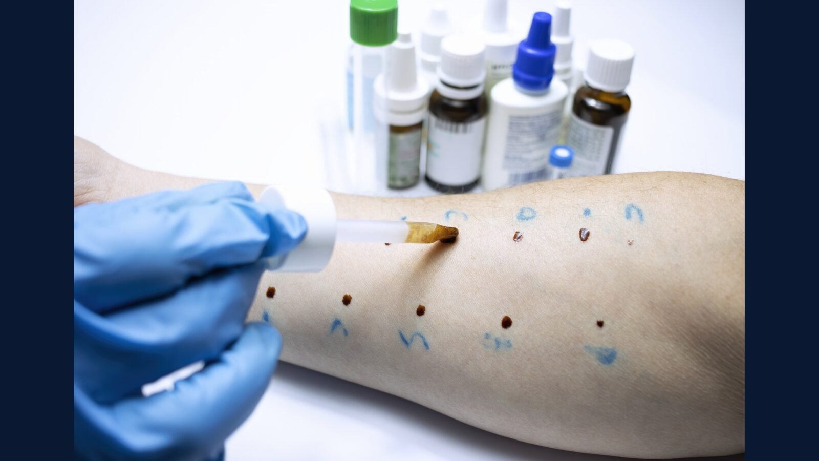 PGRSS alergia e imunologia — anti-IgE e anti-IL-5