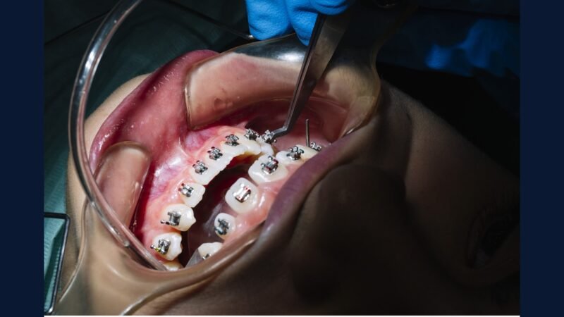 PGRSS bucomaxilofacial — ortognática e implante