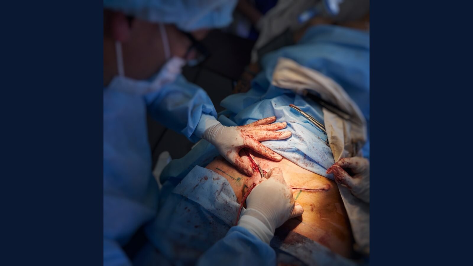 Carcinomatose Peritoneal: PGRSS CRS HIPEC Sugarbaker