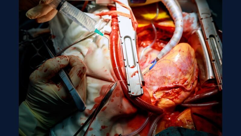 Cardiologia Avançada: PGRSS TAVI MitraClip Pulsed Field