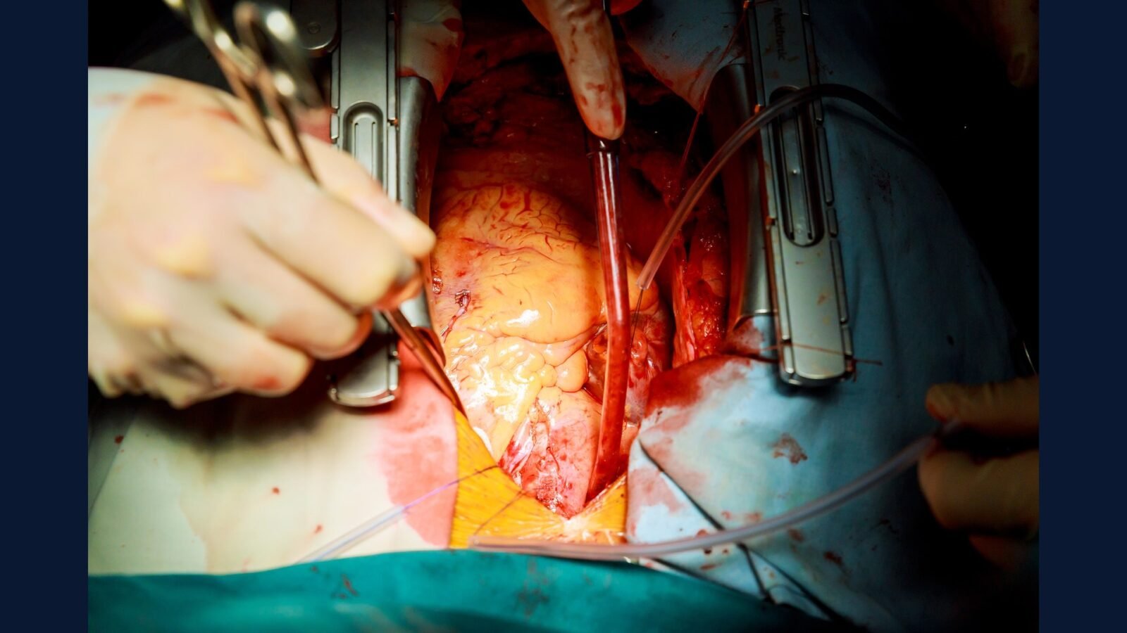 PGRSS clínica cardio intervencionista — cateter e stent