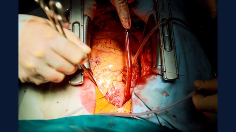 PGRSS clínica cardio intervencionista — cateter e stent