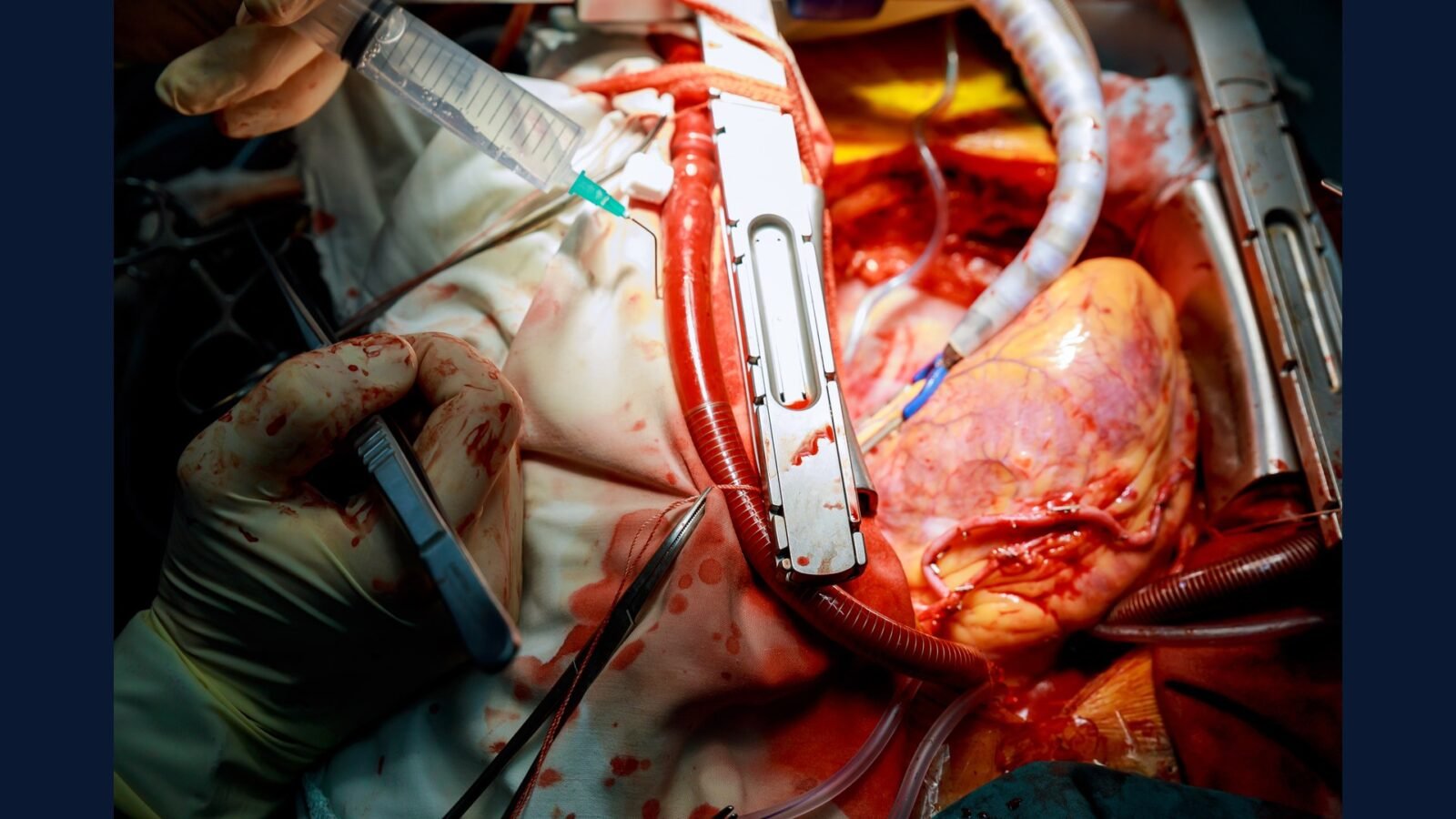 PGRSS cardiologia avançada — TAVI Watchman e ablação