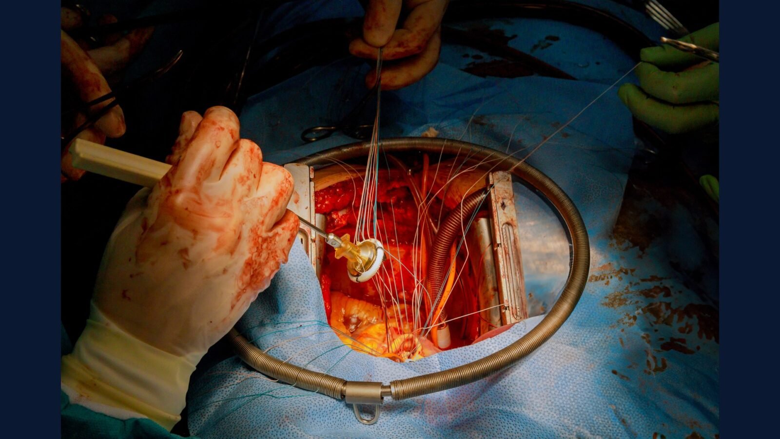 PGRSS para cardiologia intervencionista — cateterismo