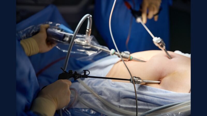 PGRSS cirurgia gastro: RYGB, sleeve e esofagectomia