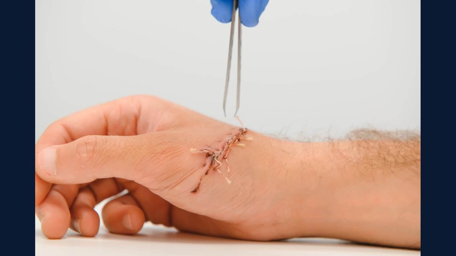 PGRSS cirurgia da mão: túnel, Dupuytren, reimplante
