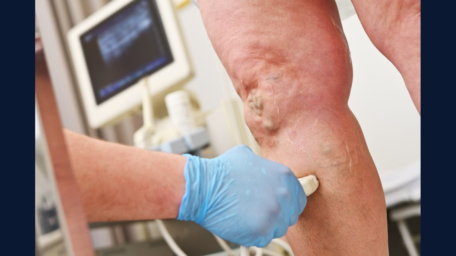 PGRSS clínica vascular adulto — varizes e úlcera venosa