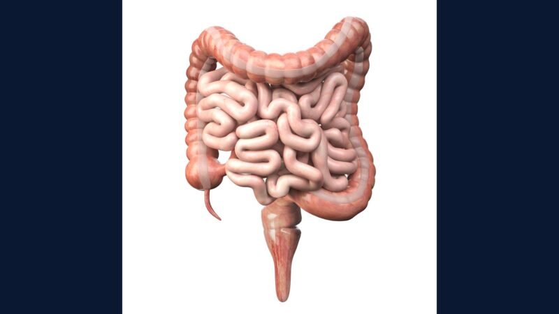 PGRSS colorretal: colectomia, Hartmann, stoma