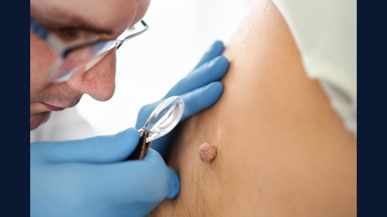 PGRSS dermato oncológica: Mohs, biópsia, criocirurgia