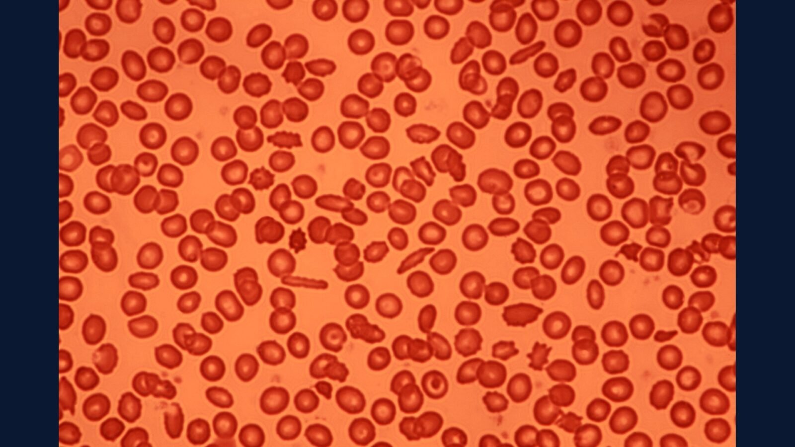 PGRSS hematologia avançada — leucemia TMO e CAR-T