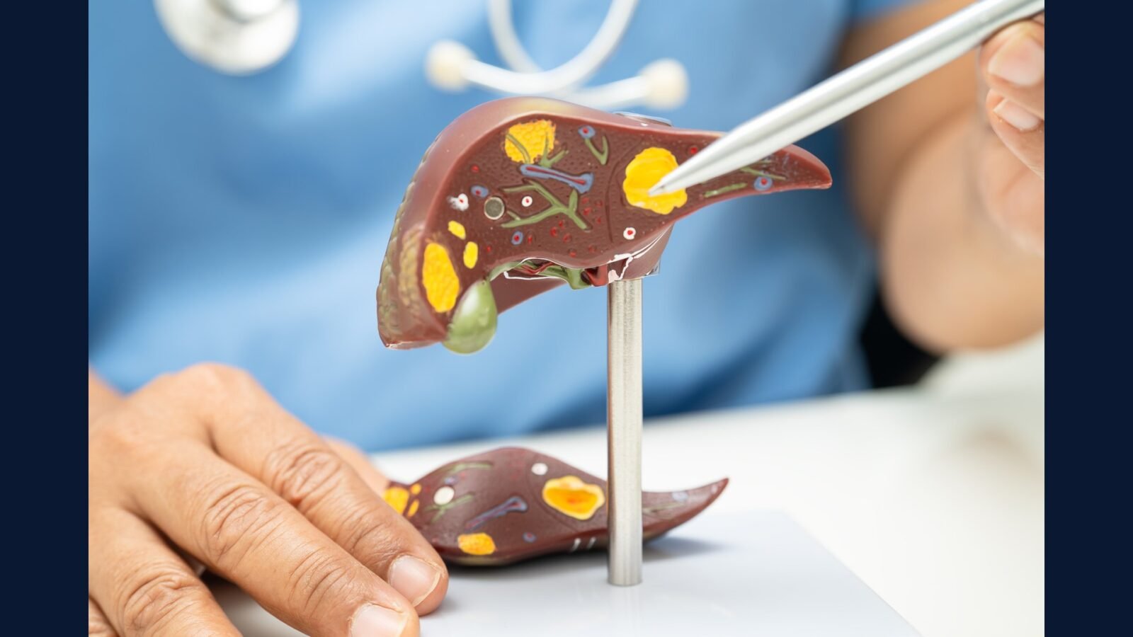 PGRSS hepatologia — cirrose CHC e transplante
