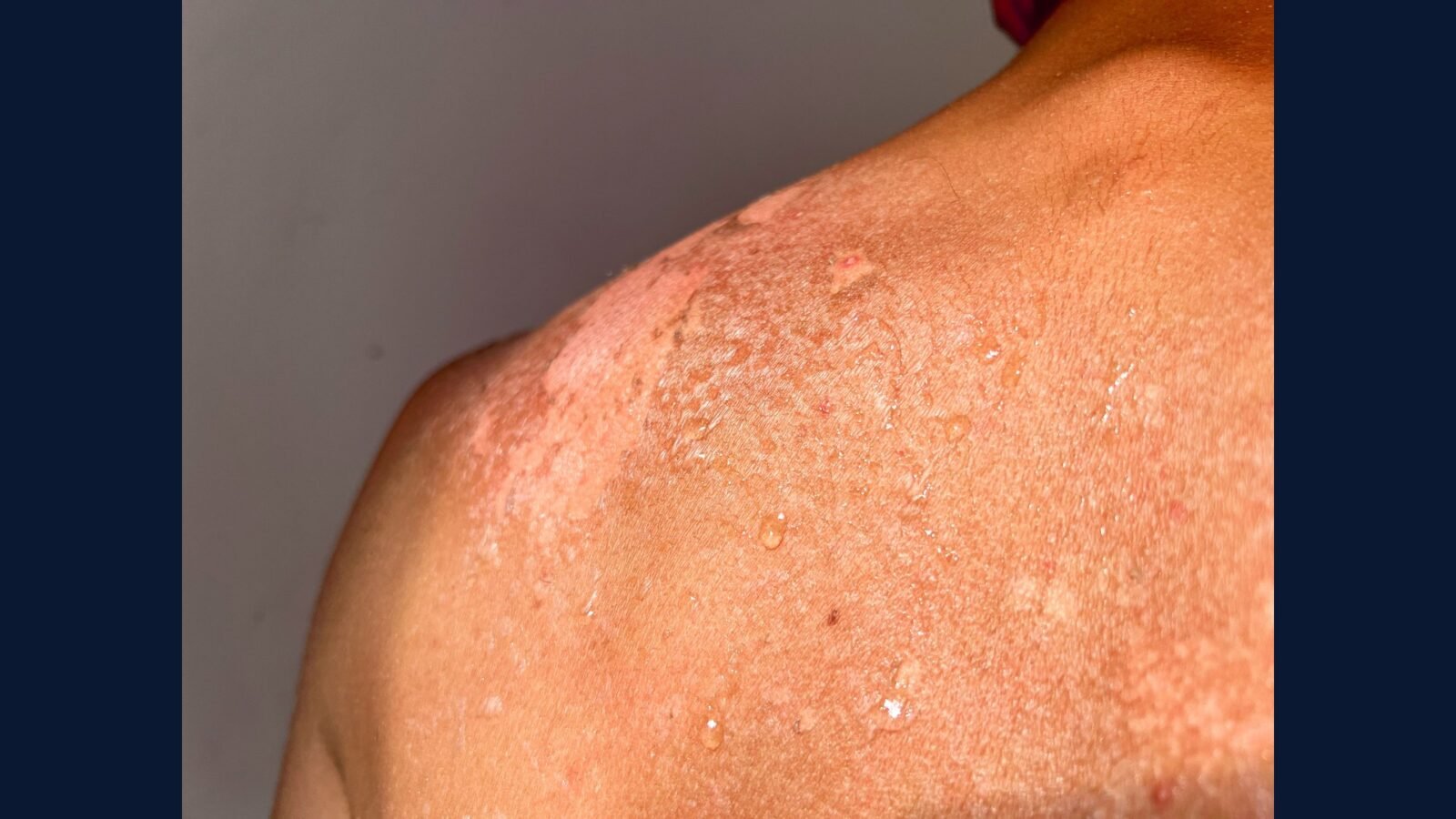 PGRSS linfoma cutâneo: CTCL, micose, CAR-T