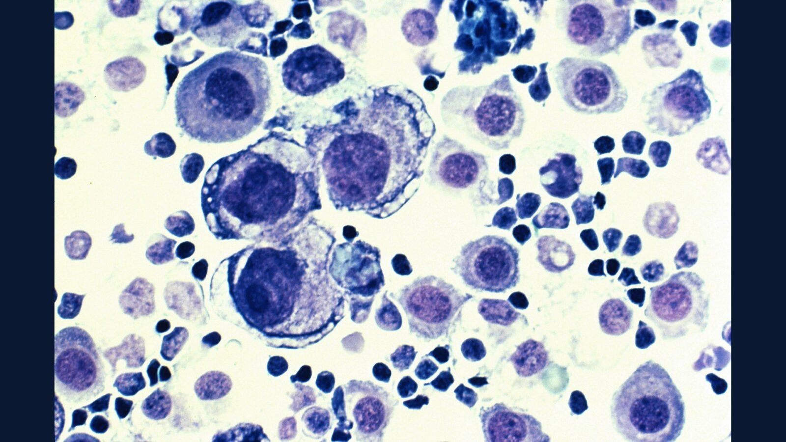 Linfoma Avancado: PGRSS R-CHOP CAR-T Bispecificos
