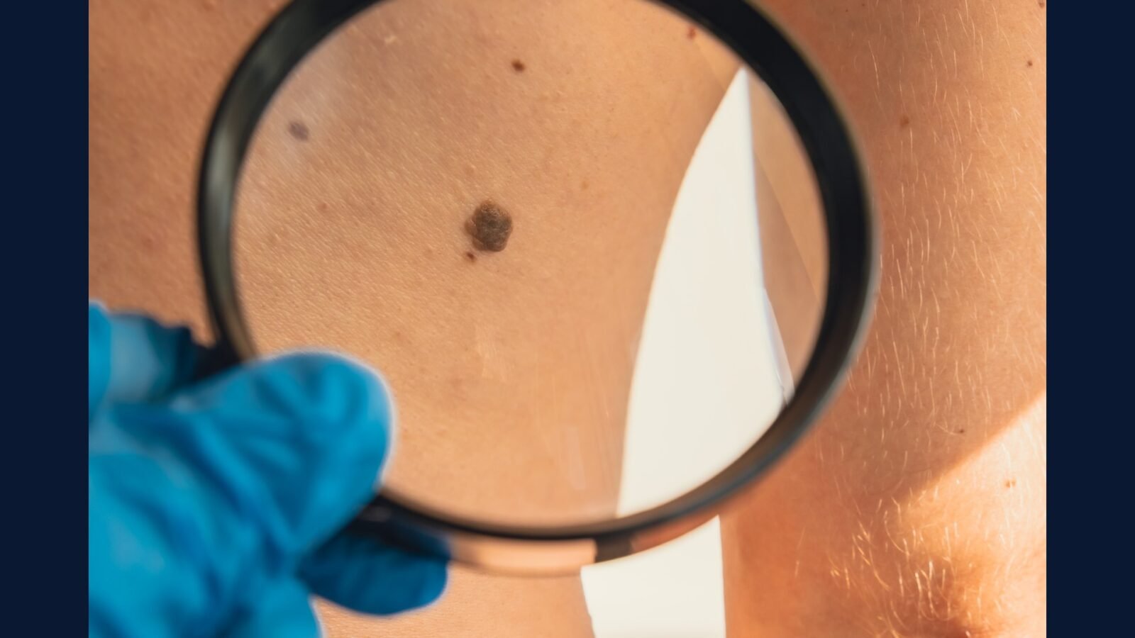 Melanoma Avancado: PGRSS Nivo Ipi CheckMate-067 TIL
