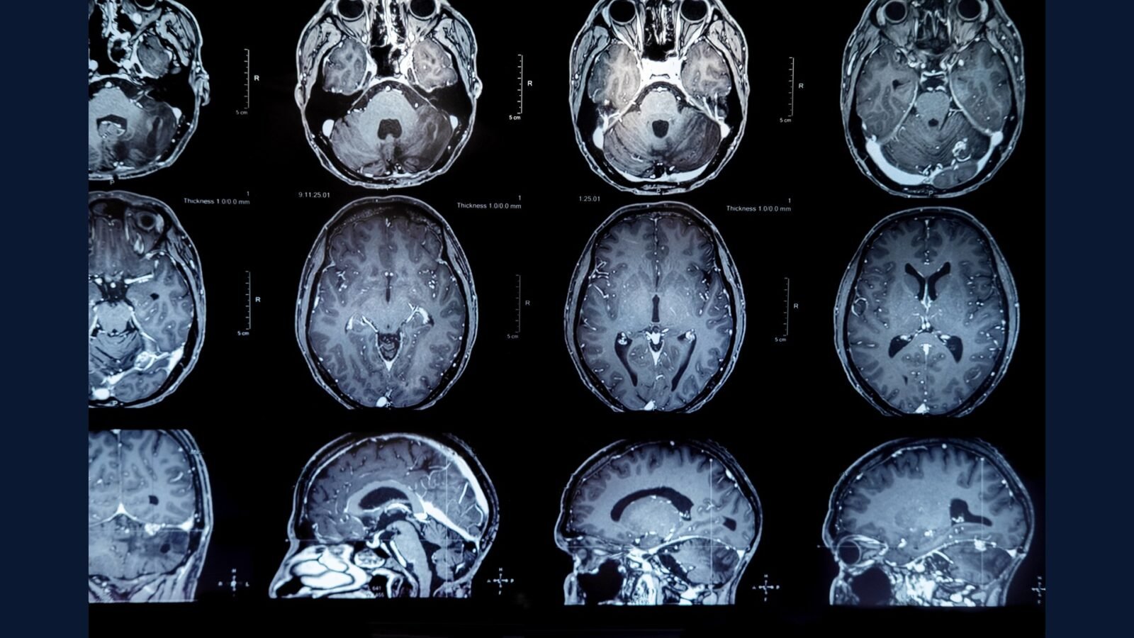 Glioblastoma: PGRSS Temozolomida TTFields Bevacizumabe