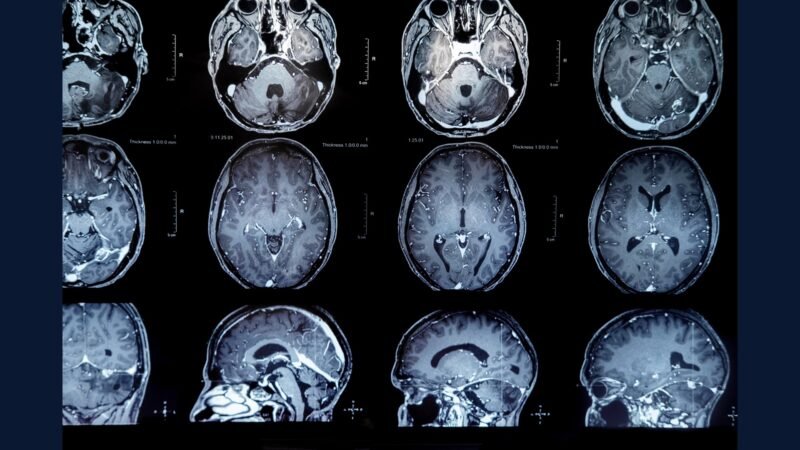 Glioblastoma: PGRSS Temozolomida TTFields Bevacizumabe
