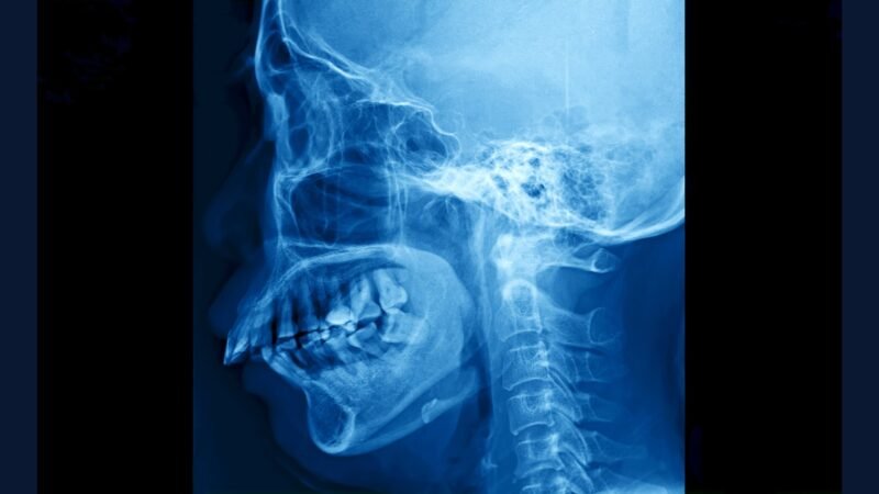 PGRSS clínica ortognática — cirurgia maxilar 3D