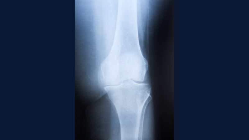 PGRSS osso: osteossarc, Ewing, condro, endopr