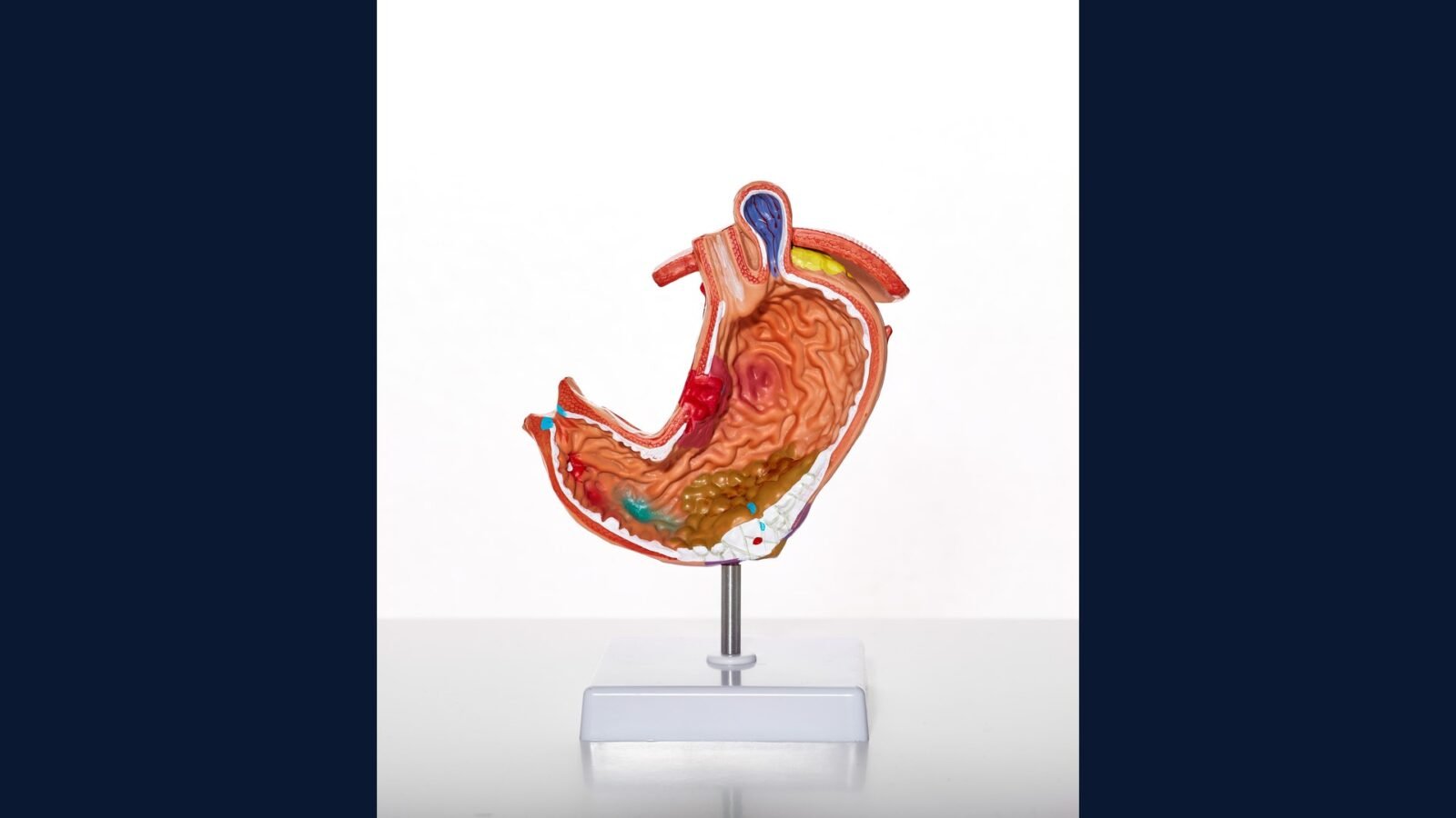 PGRSS pâncreas onc: Whipple, FOLFIRINOX, gemcitabina