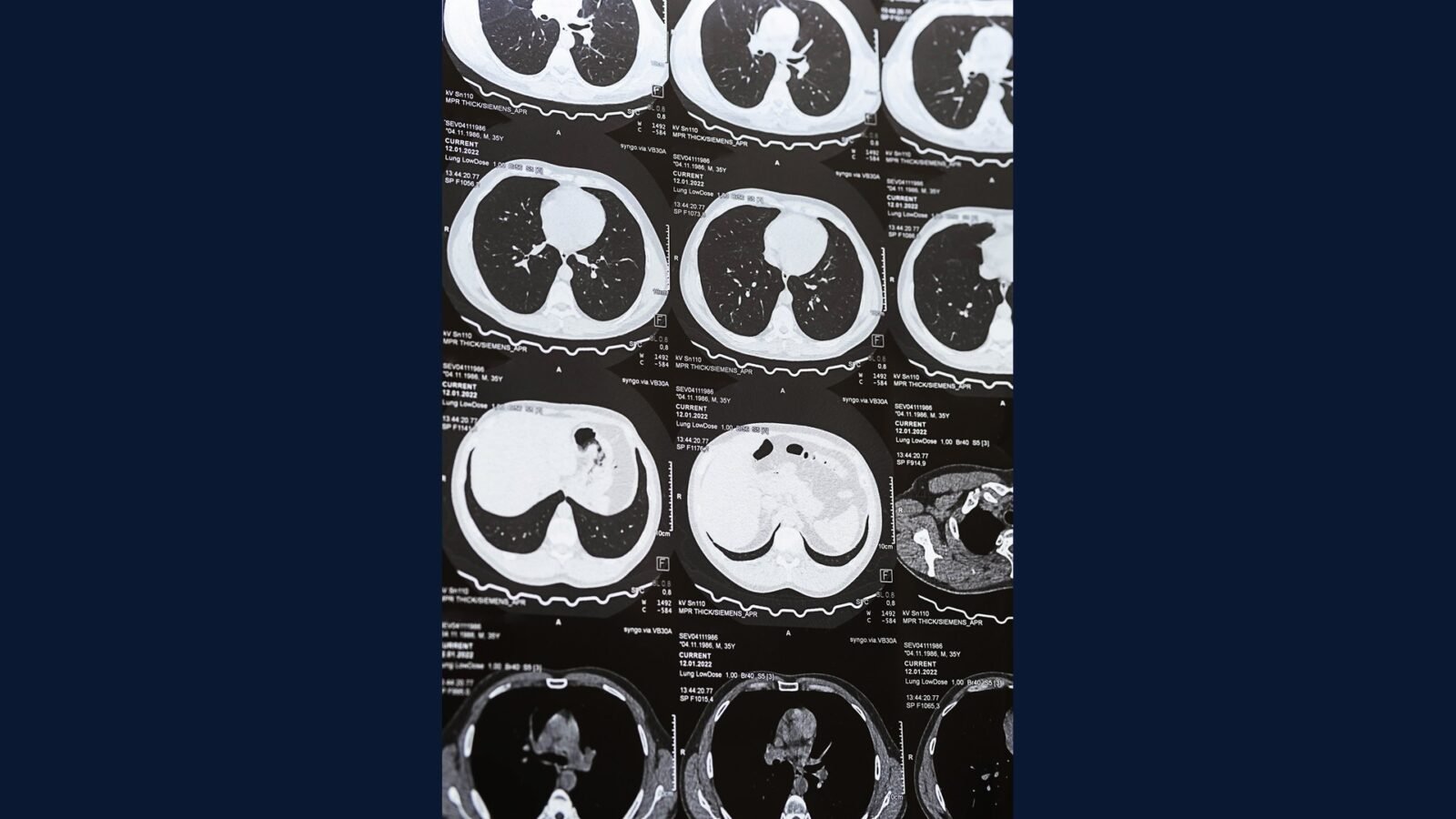 PGRSS retroper: sarcoma, lipo, leiomio, nef