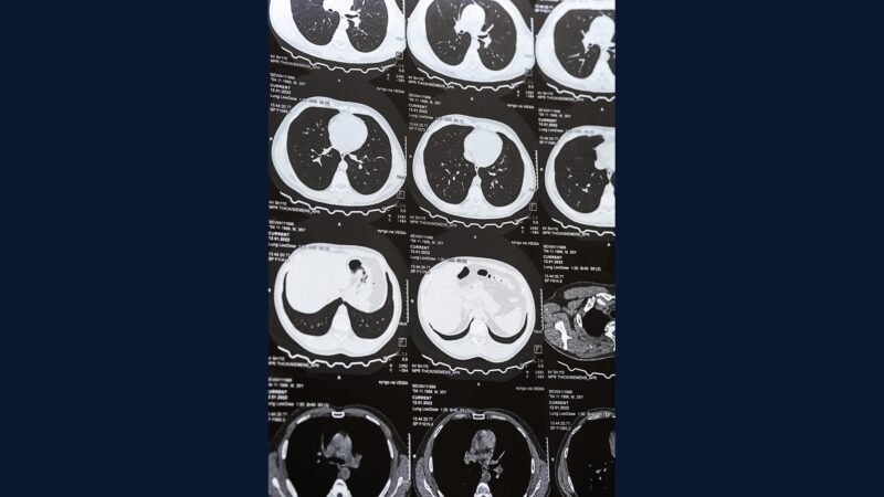 PGRSS retroper: sarcoma, lipo, leiomio, nef