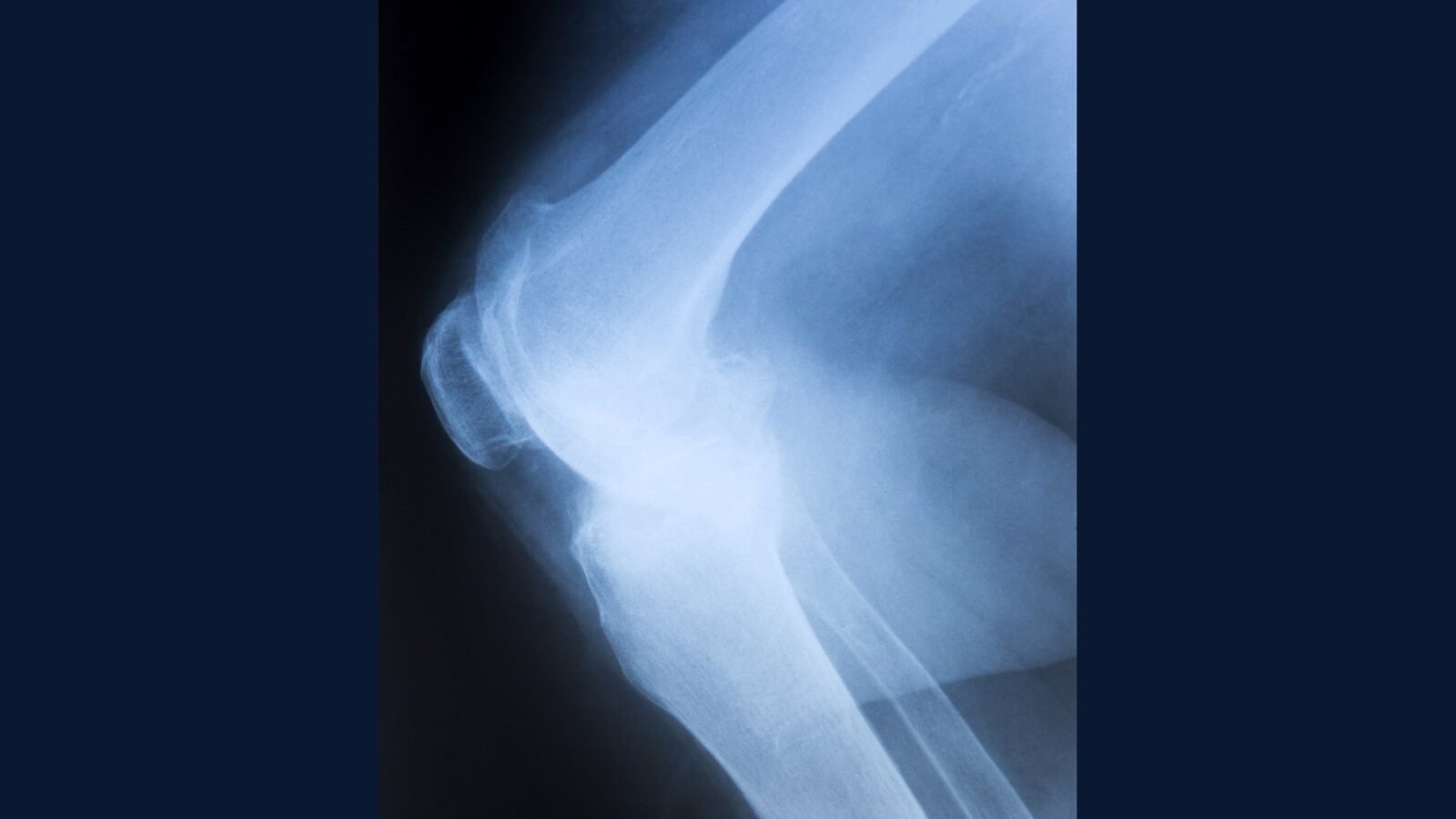 Sarcoma: PGRSS GIST Imatinibe Ripretinibe MAP VIDE
