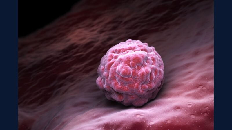 PGRSS sarcoma partes moles: adulto, RT, TKI