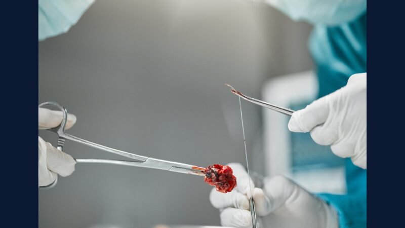 PGRSS clínica vascular avançada — endoarterectomia
