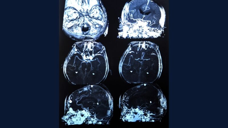 PGRSS vascular cerebral — clipagem e coiling