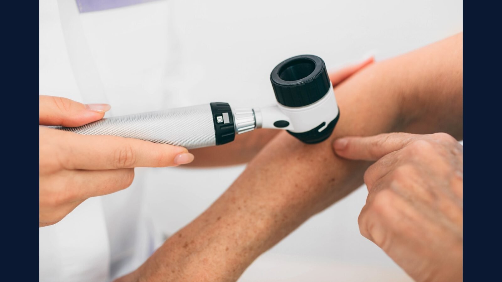 RSS em ambulatório de hanseníase — Mycobacterium leprae
