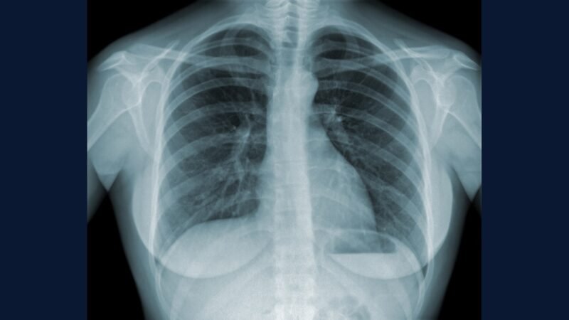 RSS em ambulatório de tuberculose — Mycobacterium