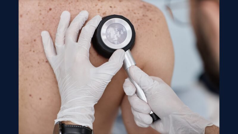 RSS dermatologia avançada — Mohs e biópsia melanoma