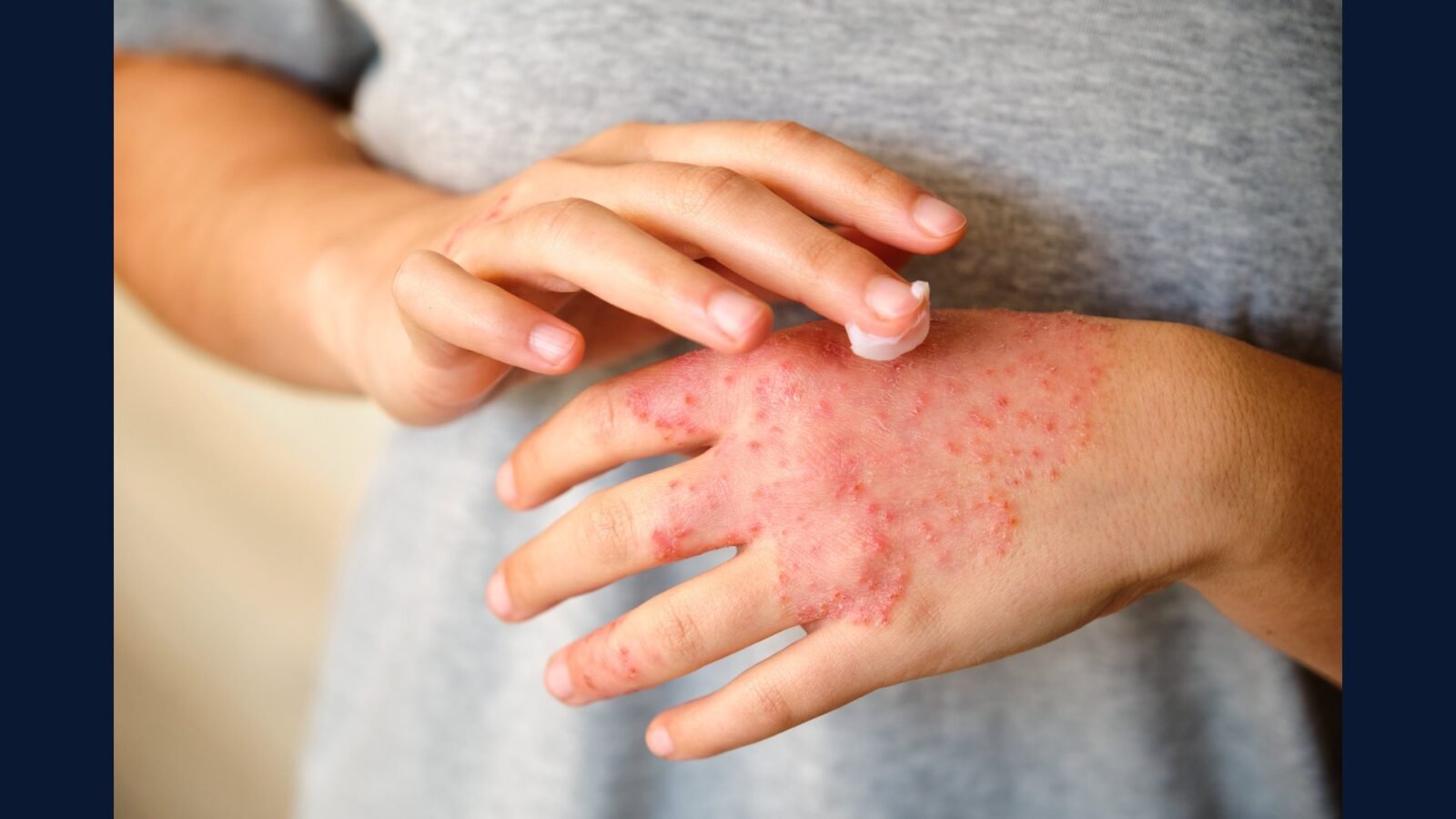 RSS dermato: psoríase, atópica, JAK, biológ