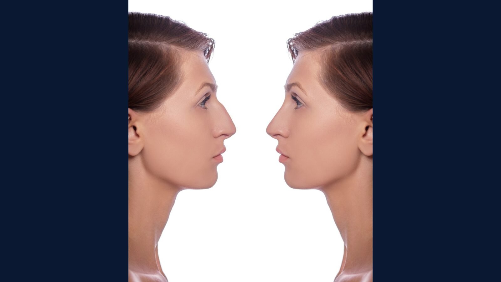RSS plástica facial: rinoplastia, blefaroplastia